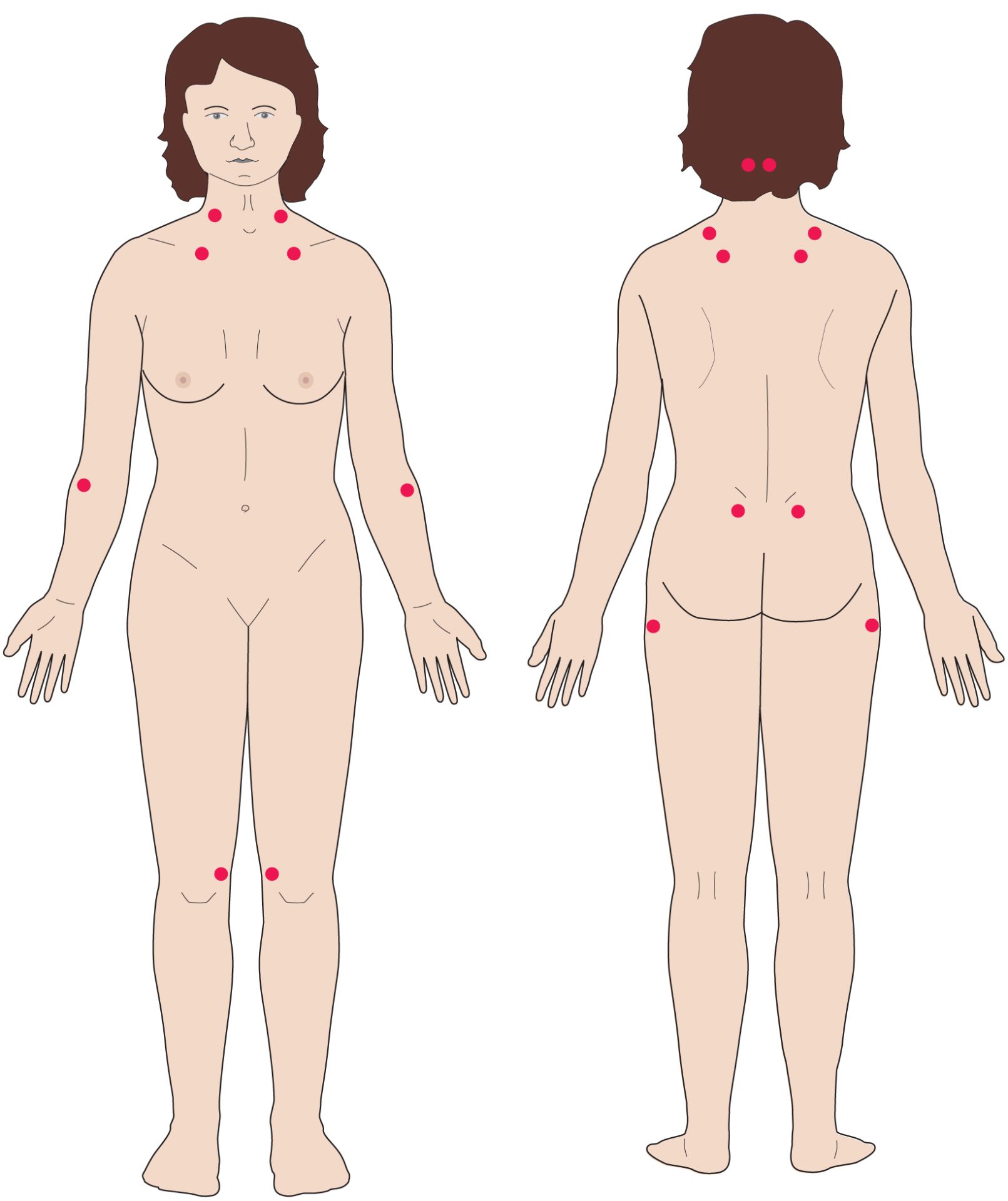Fibromyalgia ensioireet