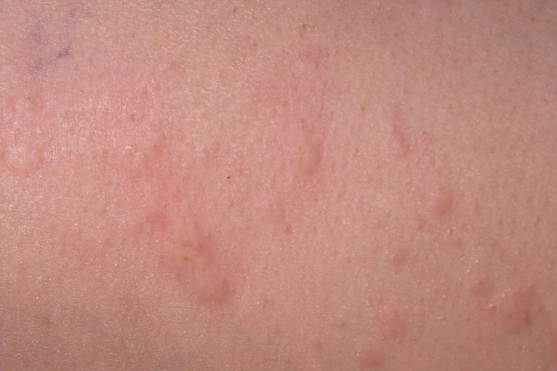 Allerginen reaktio iholla