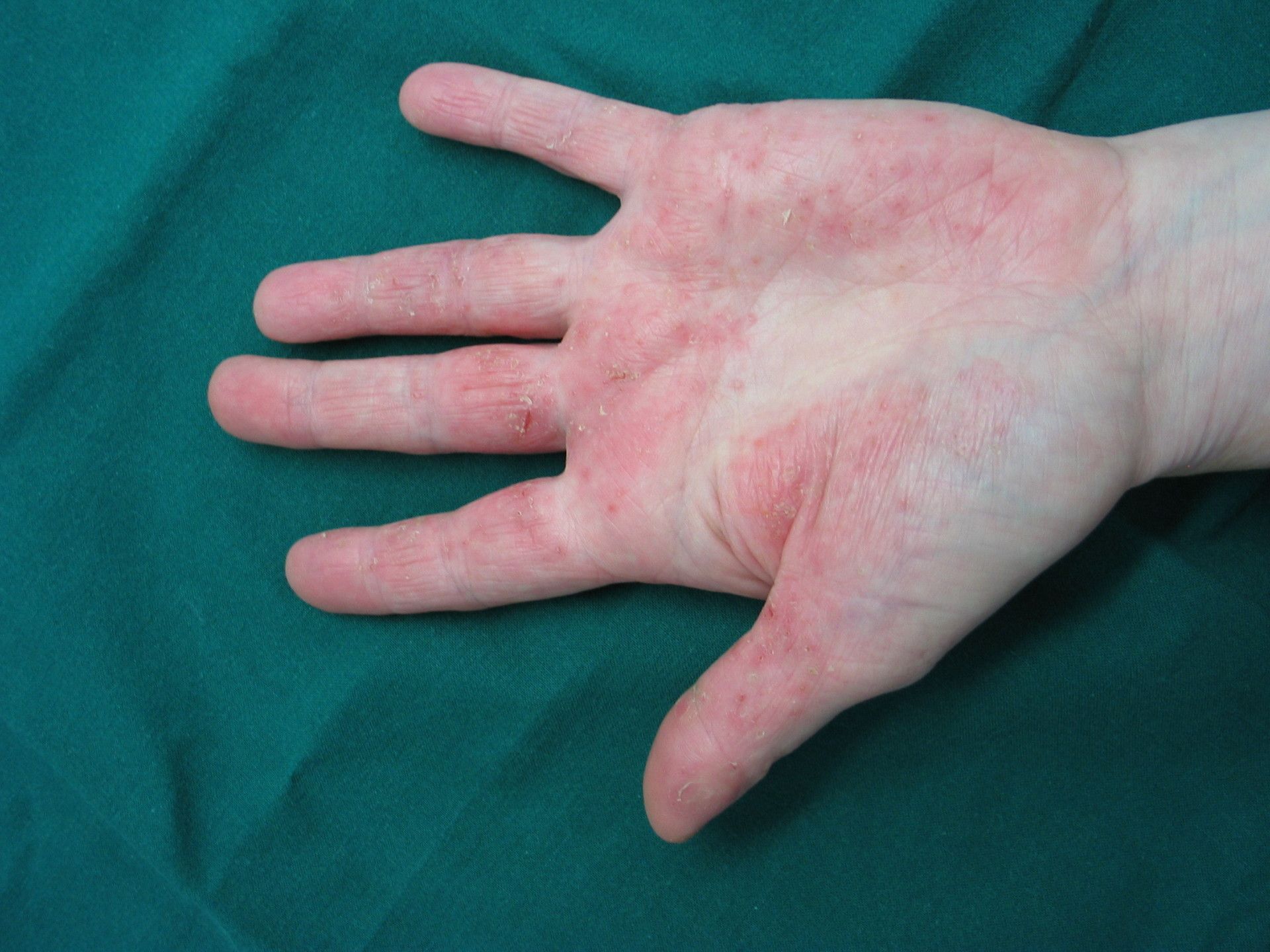 Allerginen ihottuma käsissä