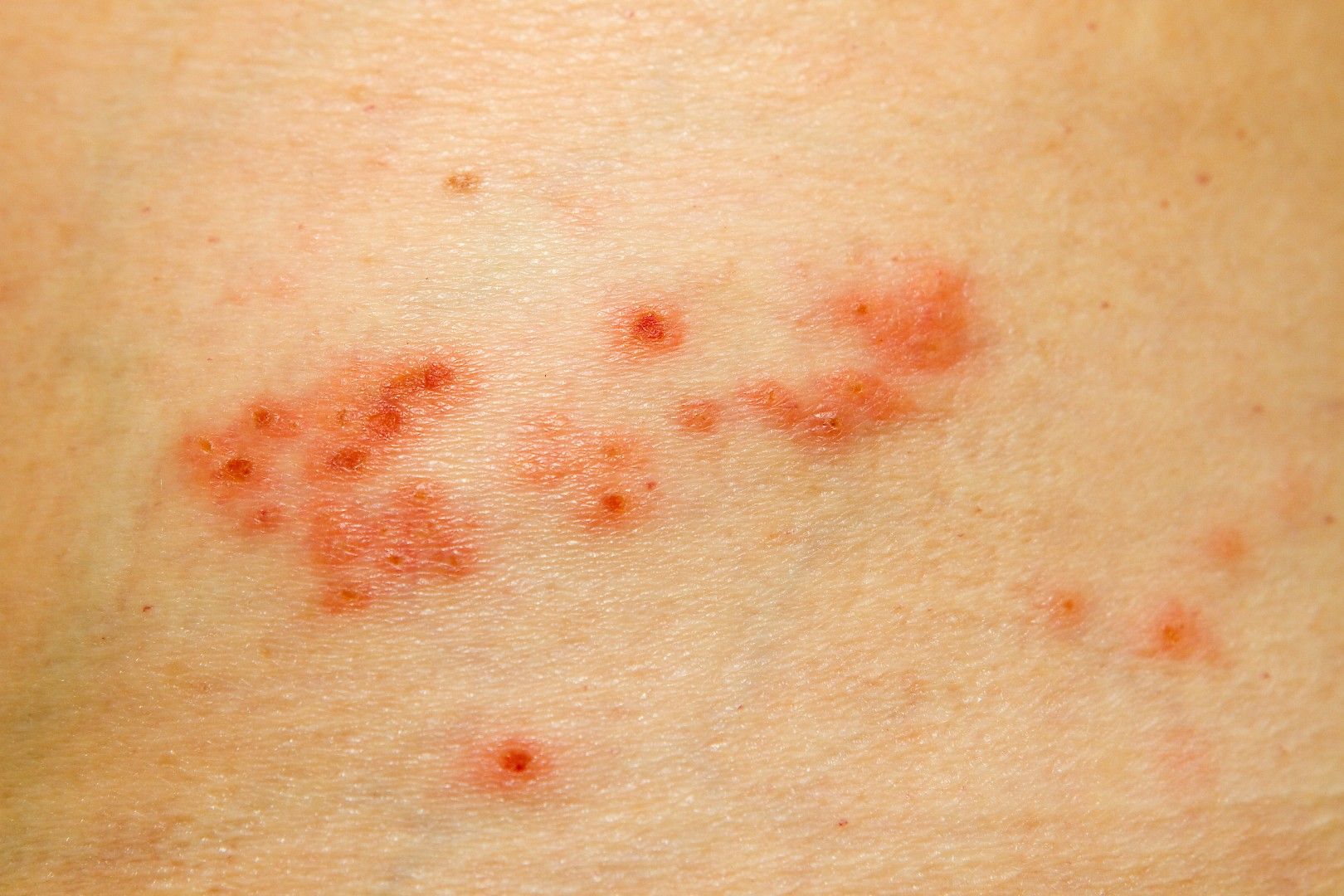 Can You Get Shingles In Your Hair