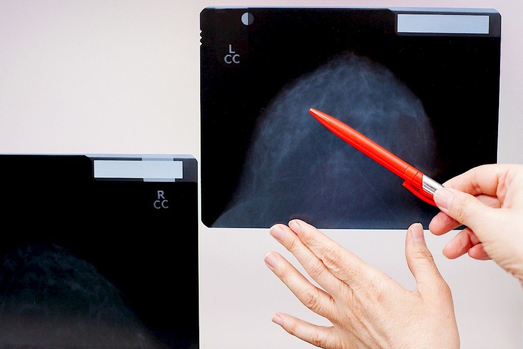 Iäkkäälle naiselle räätälöity mammografiaseuranta