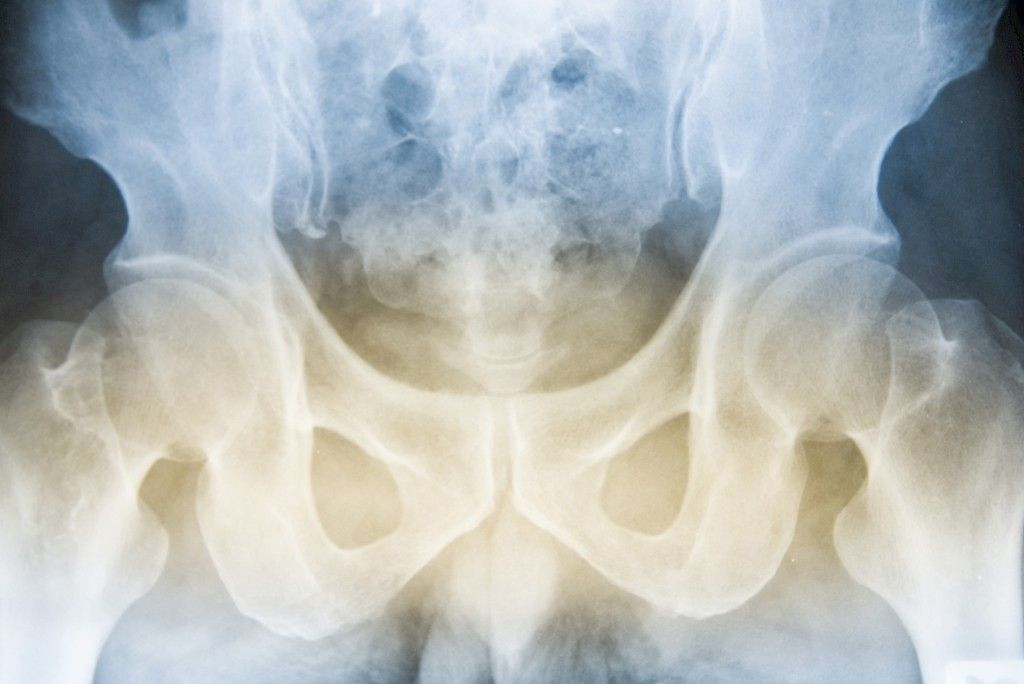 Murtumapotilaiden osteoporoosi jää liian usein vaille hoitoa