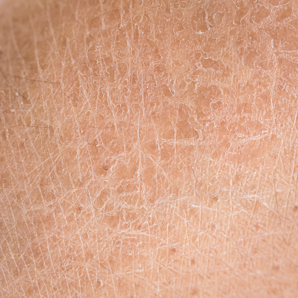 Erittäin kuiva iho voi halkeilla ja altistaa erilaisille tulehduksille.