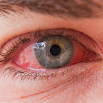 Silmätulehdus — oireet ja hoito