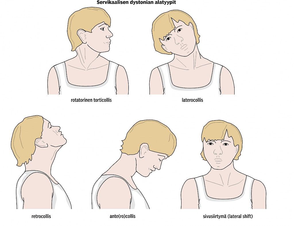 Dystoniat on hyvä osata tunnistaa