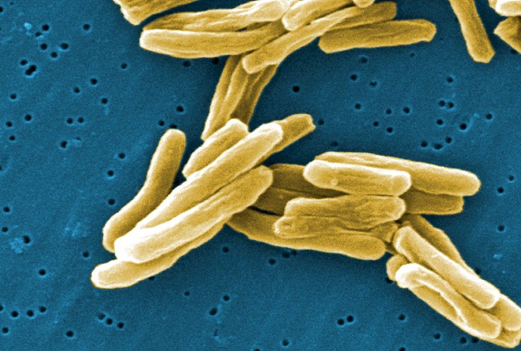 Keuhkojen ulkopuolisen tuberkuloosin osuus kasvaa