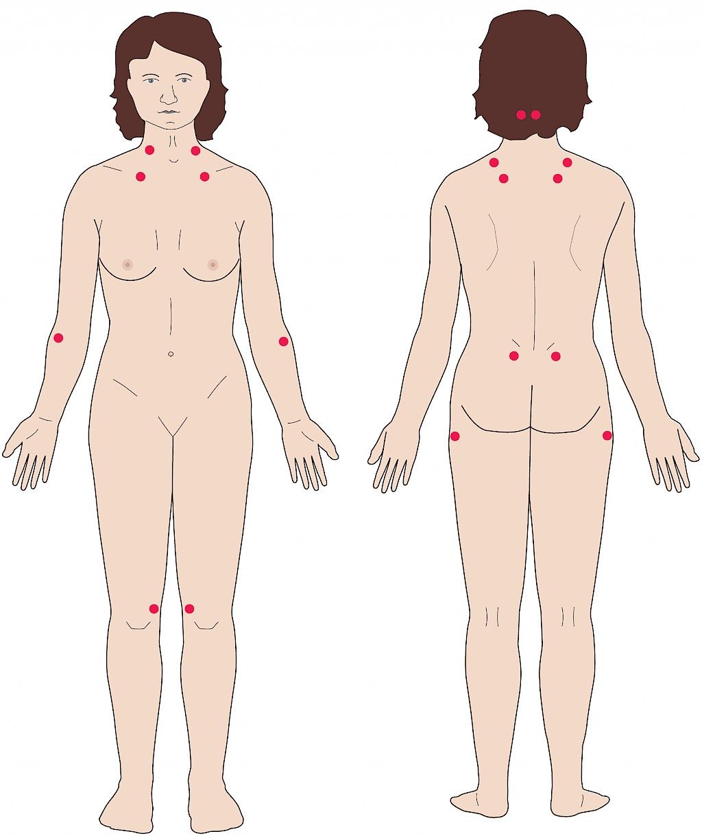 Fibromyalgian taustalla on kivunsäätelyn ja autonomisen hermoston herkistyminen