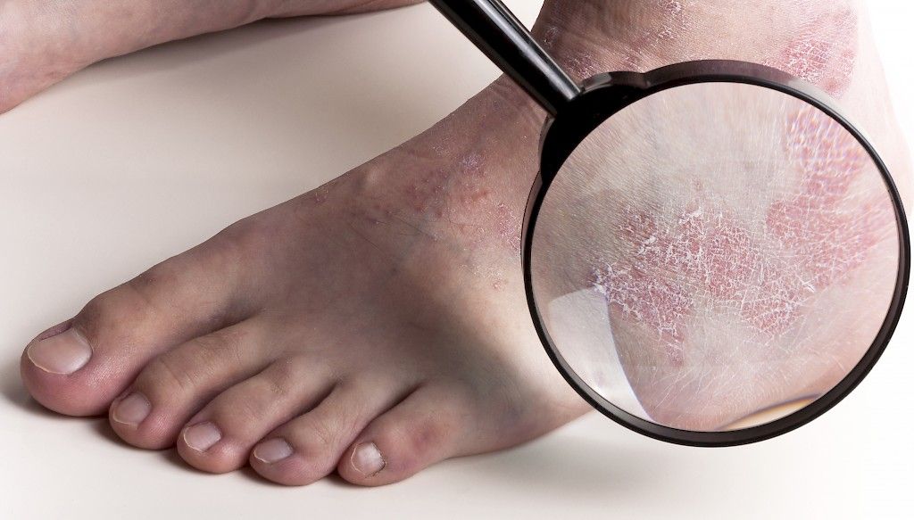 Psoriasis yhteydessä moniin muihin sairauksiin