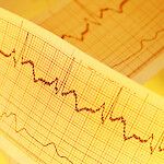 Pitkä EKG-rekisteröinti tehostaa eteisvärinän seulontaa aivoinfarktin jälkeen