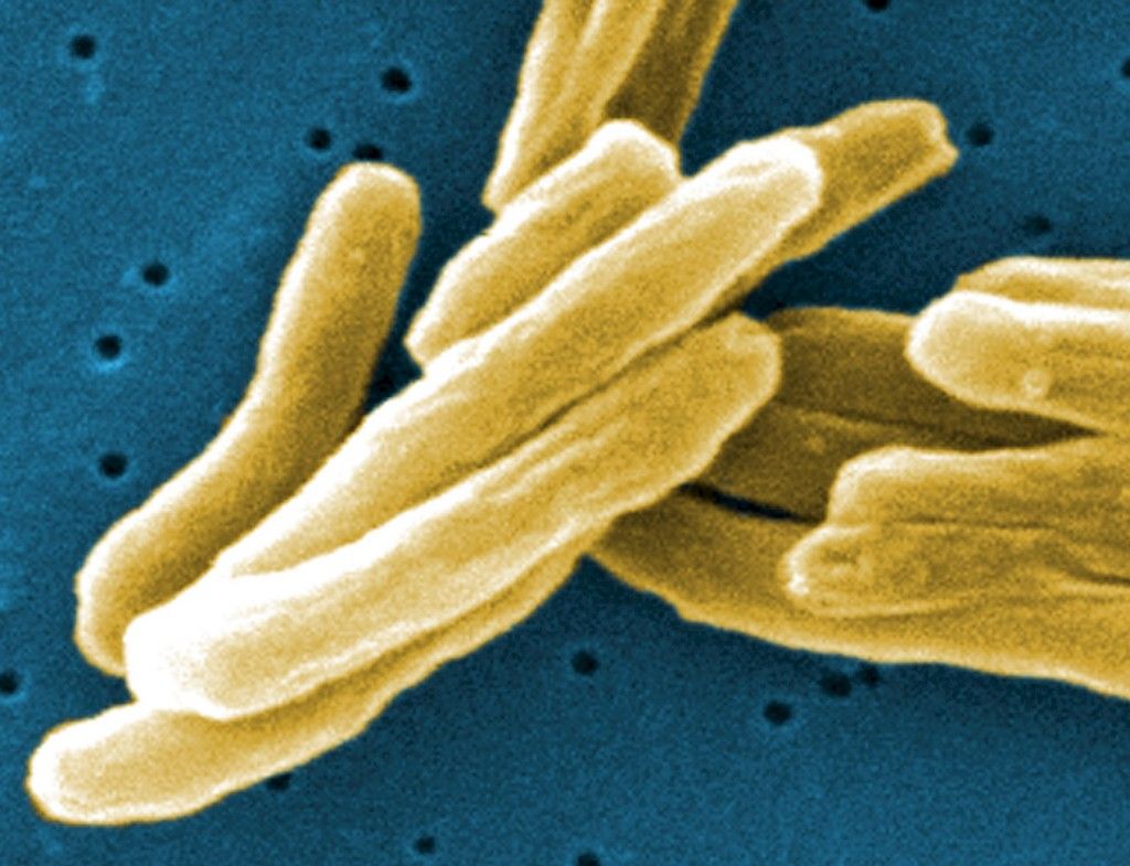 Lasten tuberkuloosi on yleisempi kuin on uskottu