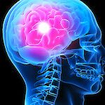 Vähäinen kuntoutus haittaa aivoverenkiertohäiriön hoitoa