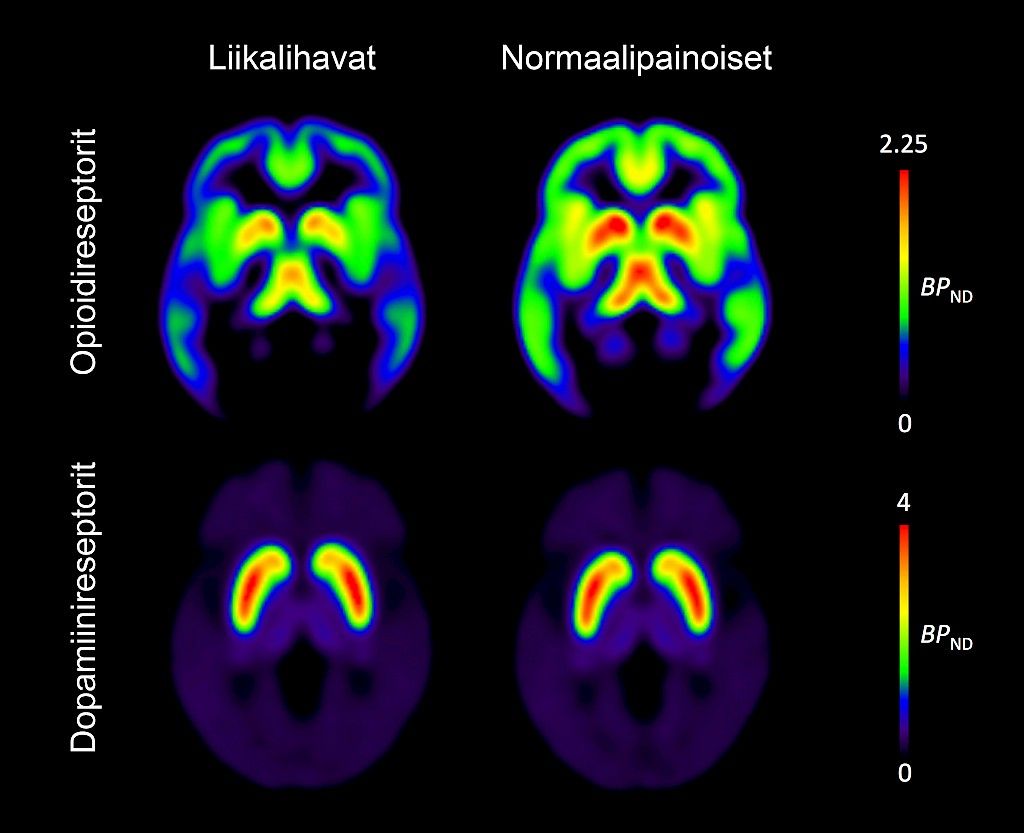 Lihavuus näkyy aivojen välittäjäaineissa