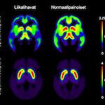 Lihavuus näkyy aivojen välittäjäaineissa