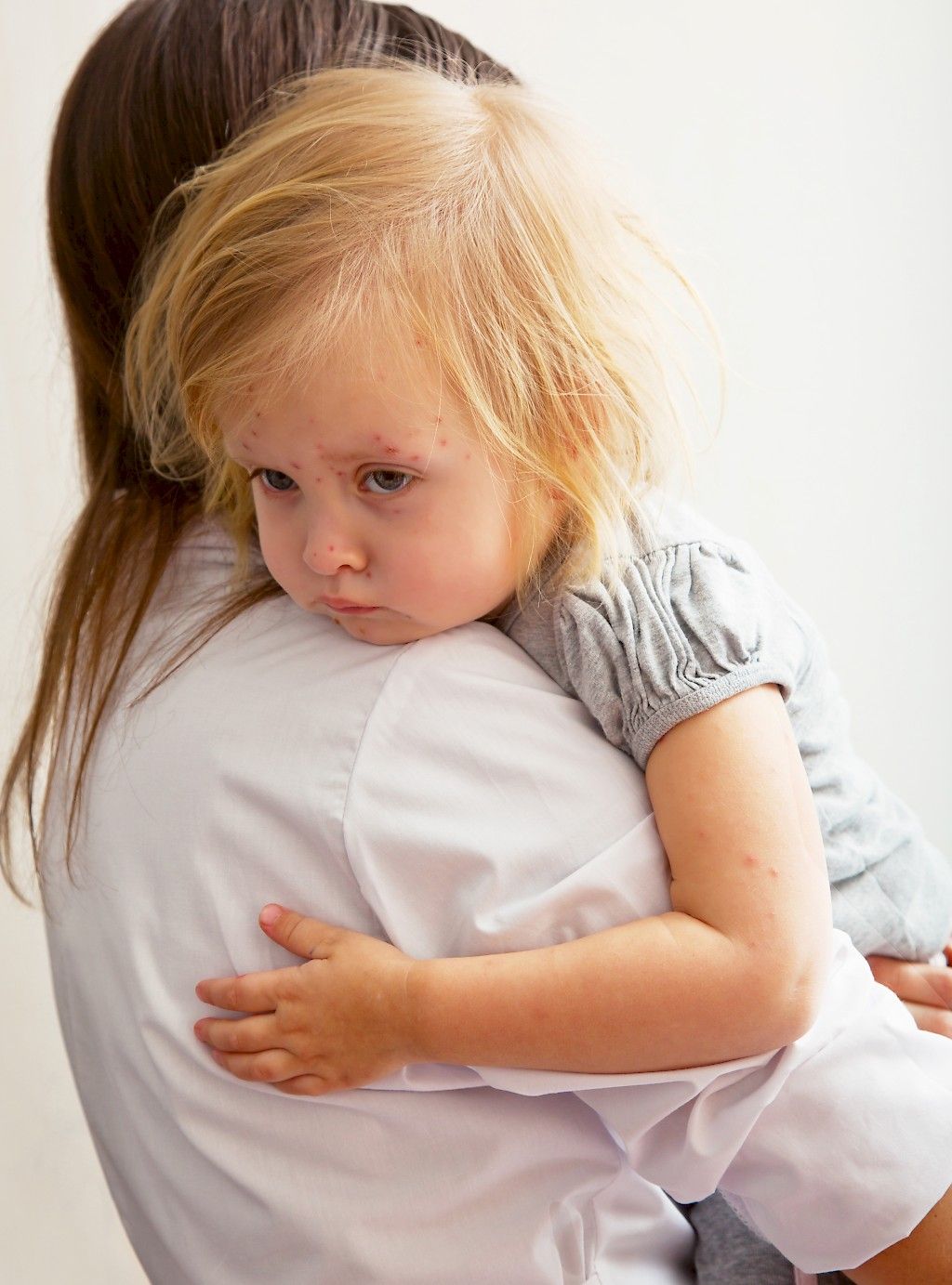 Onko tuhkarokkoepidemia mahdollinen Suomessa?