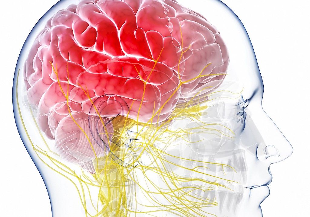 Uusi suonensisäinen hoitotekniikka parantaa aivoinfarktipotilaan ennustetta