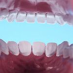 Kesäuusinta: Parodontiitti on salakavala hammasinfektio