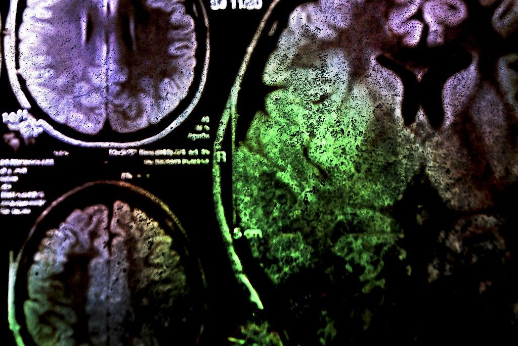 Aivojen amyloidikertymät lisääntyvät terveilläkin  iän myötä