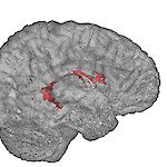 Suomalaistutkijat: Krooniselle kivulle ja aivojen suonipunokselle löytyi odottamaton yhteys