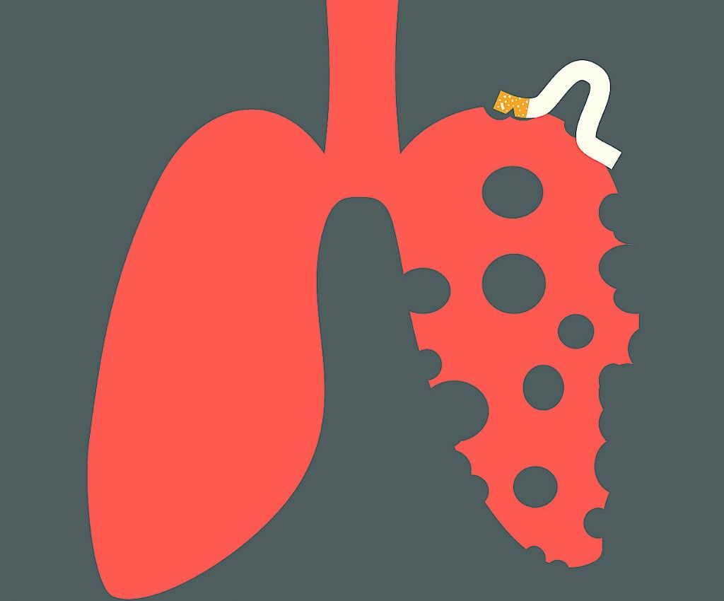 Keuhkoahtaumatauti lisää aivotapahtuman riskiä