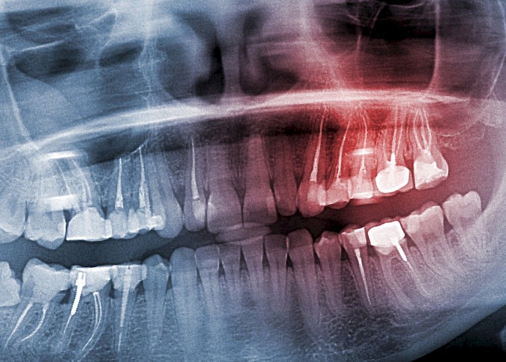 Implanttien komplikaatiot ovat tavallisia