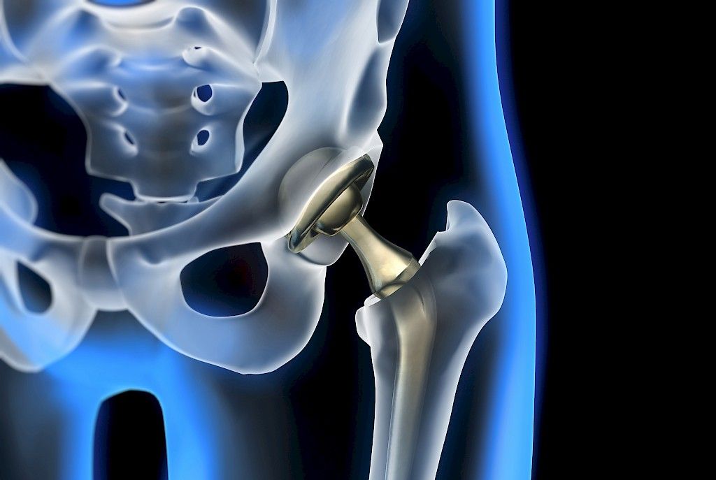 Ortopedit ovat huolissaan implanttirekisteristä