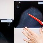 Iäkkäälle naiselle räätälöity mammografiaseuranta
