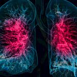 Onnistuuko keuhkoahtaumapotilaalta lääkkeen hengittäminen keuhkoihin?