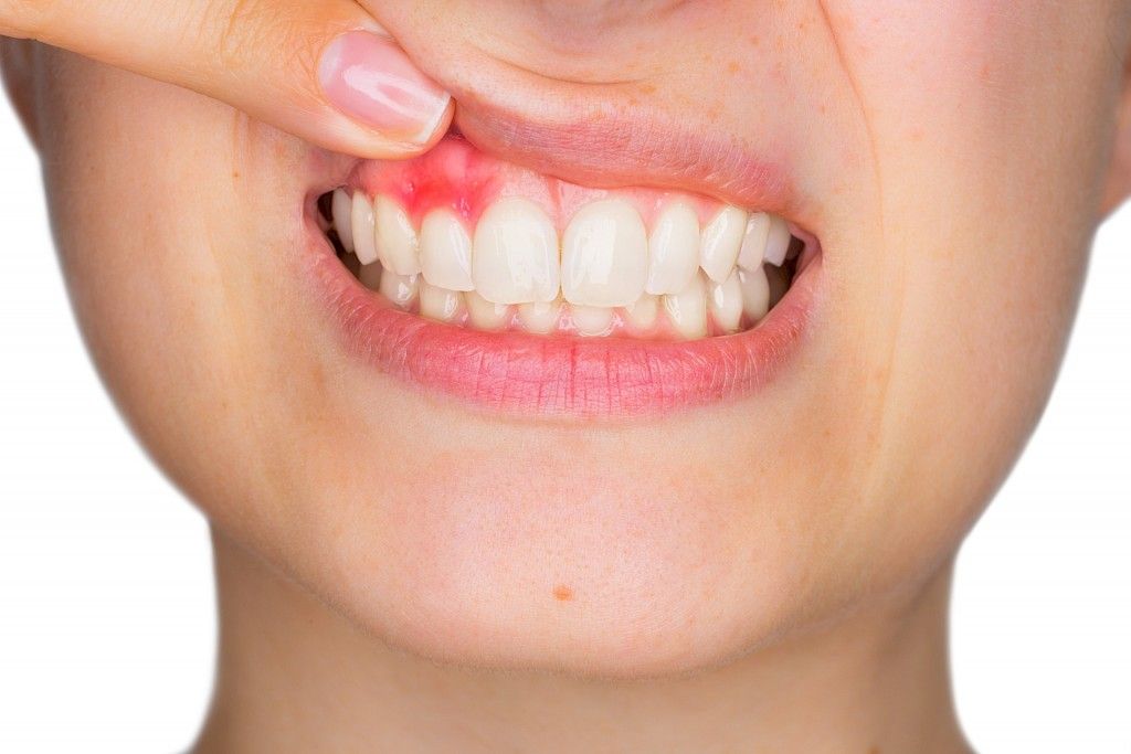 Yleinen suun bakteeri saattaa vaikeuttaa hedelmöittymistä