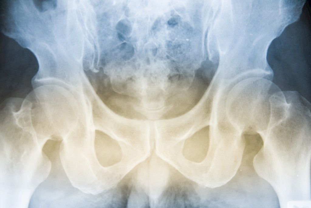 Murtumapotilaiden osteoporoosi jää liian usein vaille hoitoa