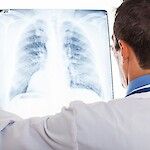 Miten keuhkosyövän ennustetta voisi parantaa?