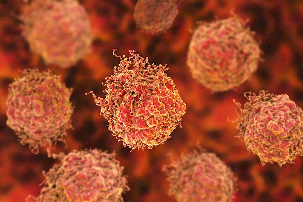 Imusolmukkeisiin levinneen eturauhassyöpä ei ole parantumaton