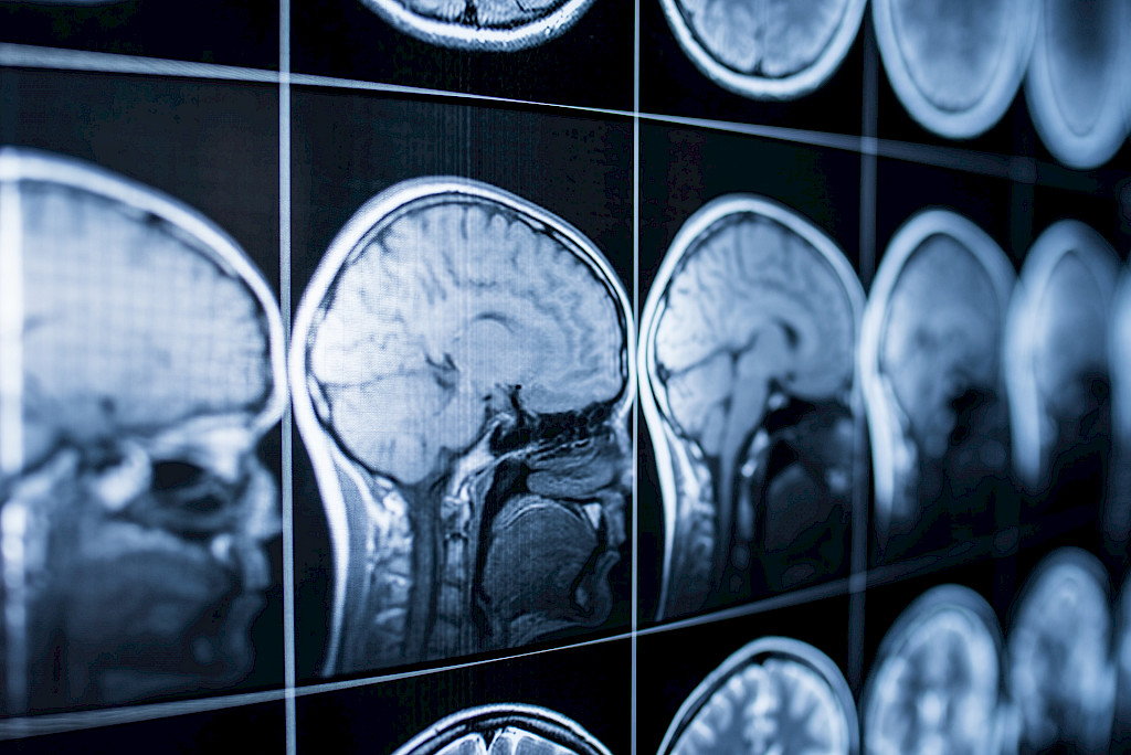 Psykoosilääkkeet yhteydessä aivovammoihin Alzheimerin tautia sairastavilla