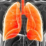 Inhaloitava kortikosteroidi altistaa keuhkoahtaumapotilaan pseudomonakselle
