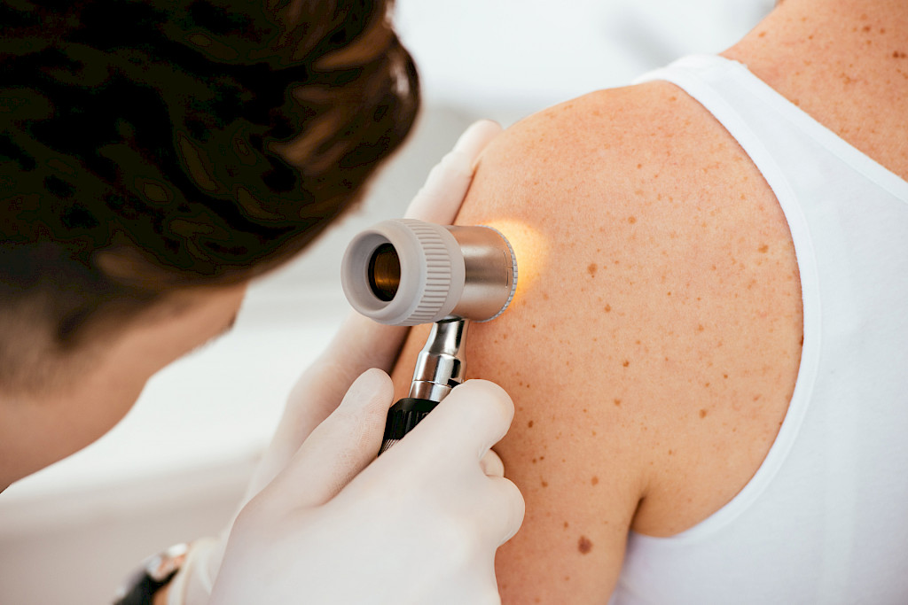 Pohjois-Savossa korkea melanoomakuolleisuus – aggressiivisia melanoomia entistä enemmän