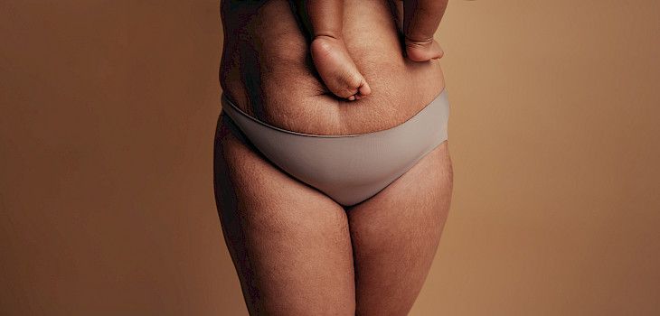 Tutkimustulos: Yhden raskauden jälkeen keskimääräinen vatsalihasten erkauma on noin 2,5 senttimetriä
