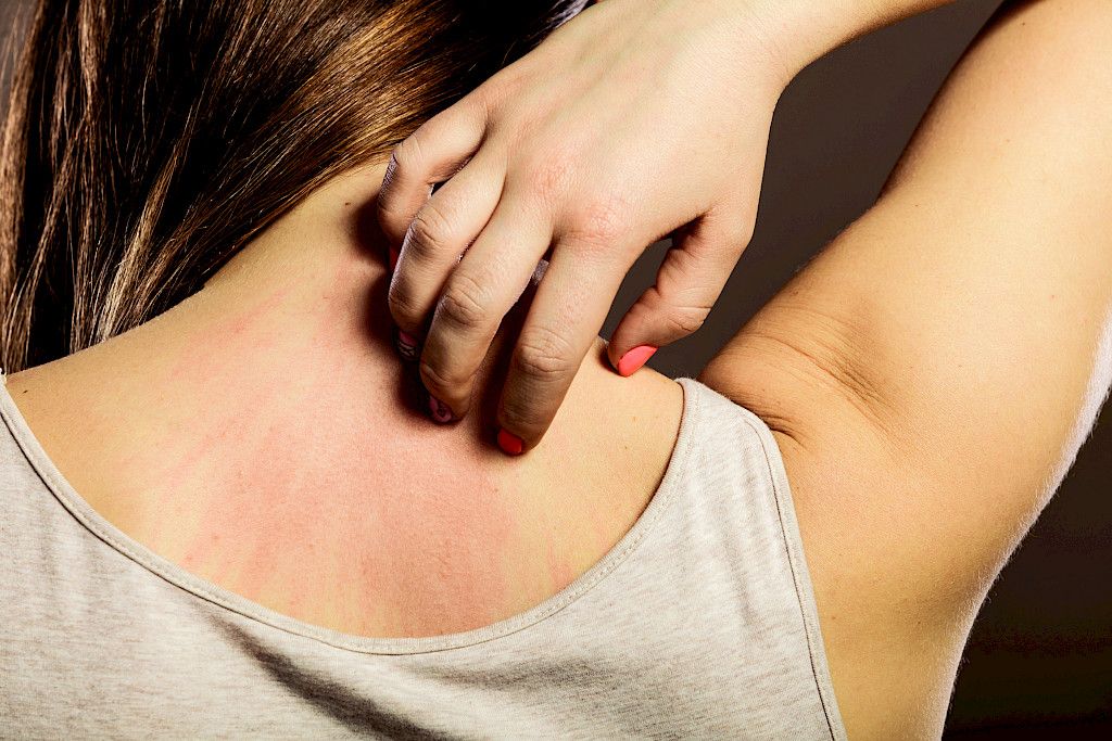 Atoopikoilla siitepölykausi voi pahentaa iho-oireita.