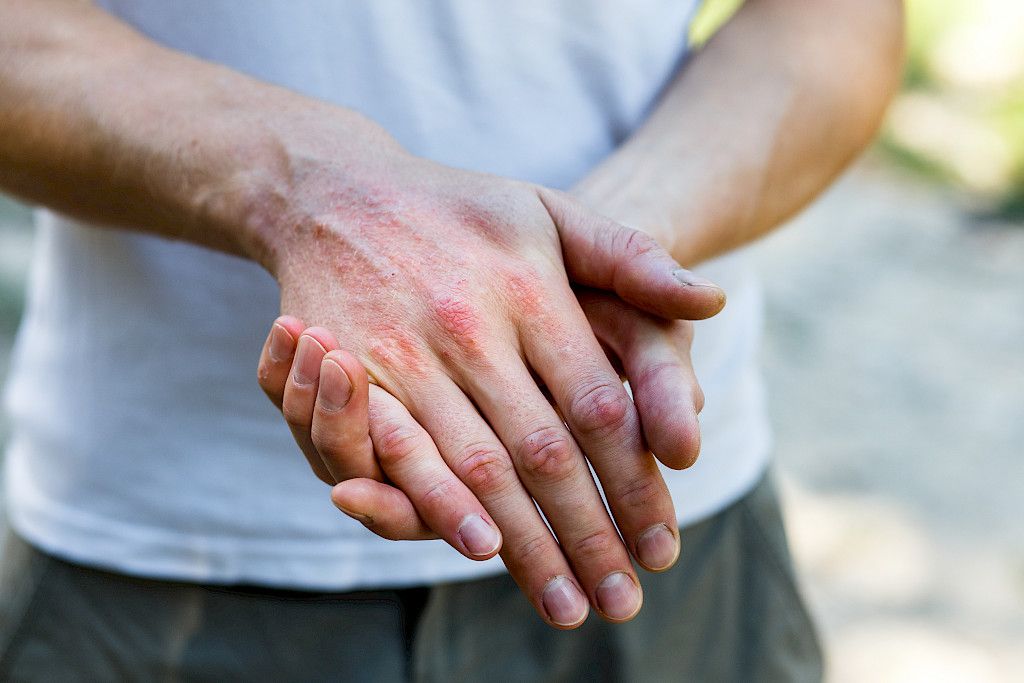 Atooppinen ihottuma oirelee usein käsissä.