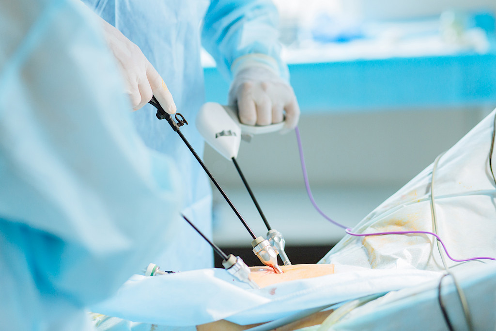 Vatsaontelon tähystys eli laparoskopia on yksi endometrioosin hoitokeinoista.
