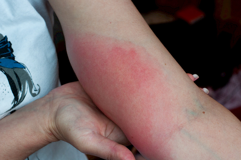 Ampiaisen pisto voi aiheuttaa allergisen reaktion.