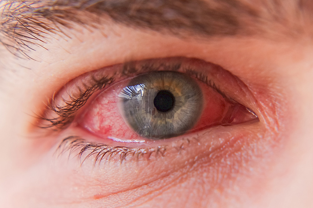 Sidekalvon bakteeritulehdus aiheuttaa yleensä voimakasta punoitusta silmään.