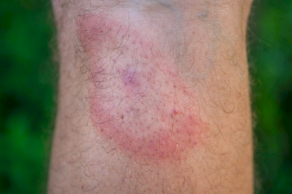 Yli 5 cm:n mittainen iho-oire, jonka keskusta vaalenee, on merkki alkavasta borreliainfektiosta.