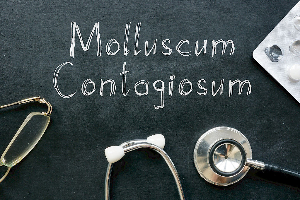 Ontelosyylät eli molluskat aiheuttaa ontelosyylävirus.
