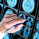 Alzheimerin taudin diagnostiikassa voi hyödyntää verikoetta
