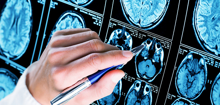 Alzheimerin taudin diagnostiikassa voi hyödyntää verikoetta