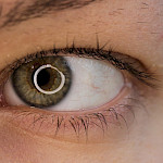 Retinopatia on salakavalasti etenevä uhka näkökyvylle