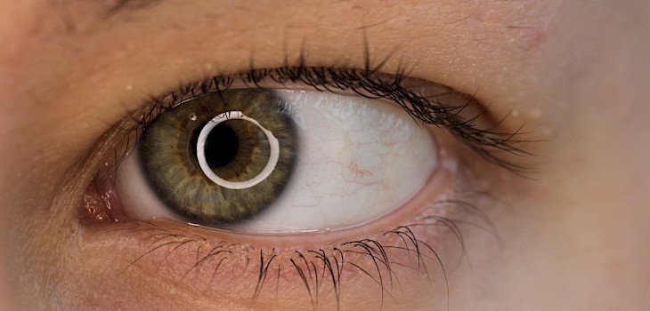 Retinopatia on salakavalasti etenevä uhka näkökyvylle