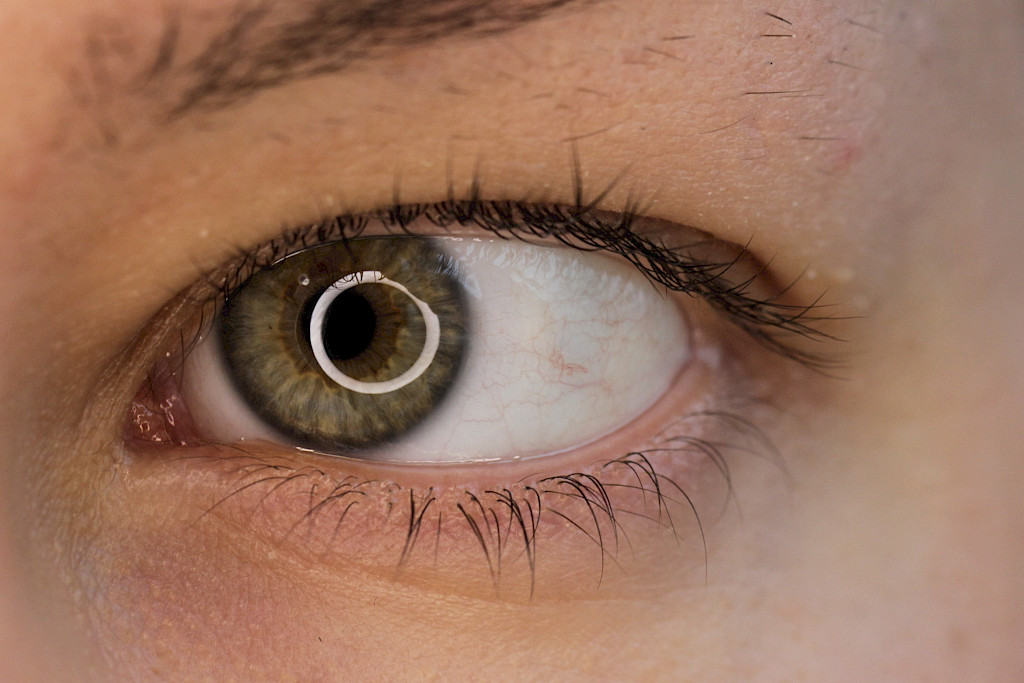 Retinopatia kehittyy hitaasti ja ilman kipua. Siksi se on erityisen salakalava.