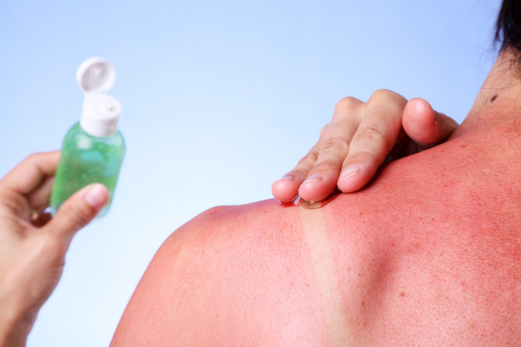 Aloe vera -geeli lievittää auringon polttaman aiheuttamaa kipua ja kuumotusta tehokkaasti.