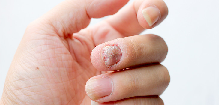 Miten psoriasis vaikuttaa kynsiin?