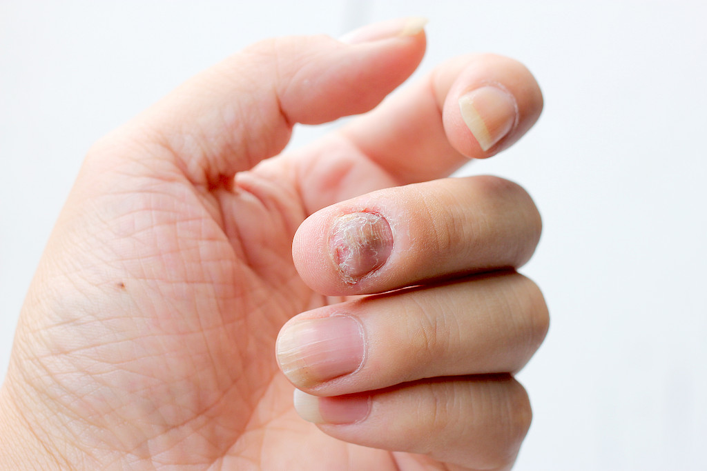 Psoriasis voi vaikuttaa myös kynsiin.